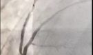 急诊冠脉造影+支架植入术